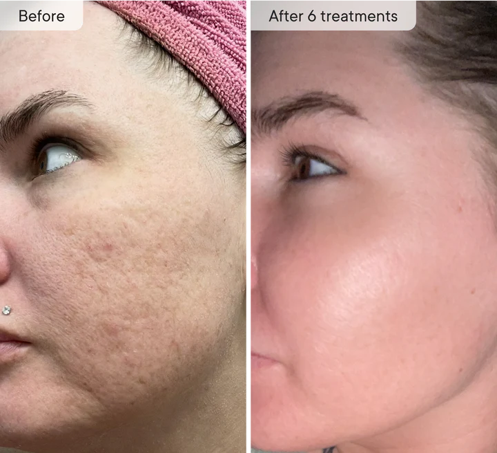 Qure Micro Infusion System for Face & Neck - Facial Moisturizing Essence