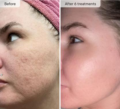 Qure Micro Infusion System for Face & Neck - Facial Moisturizing Essence